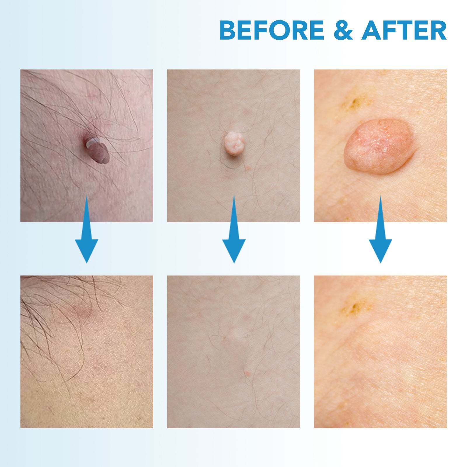 Kit traitement des acrochordons