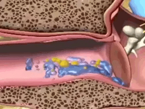 Nettoyeur d'Oreilles Electrique