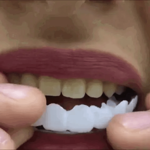 Facettes dentaires artificielles